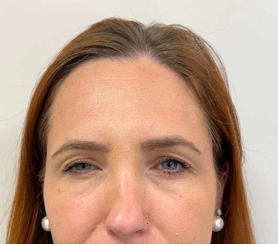 Botox em Curitiba na clínica de estética SENCIÊ no Batel