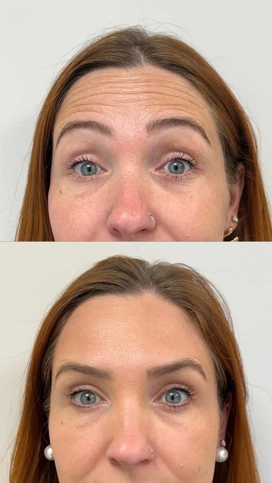 Botox para rejuvenescimento na clínica de estética SENCIÊ no Batel em Curitiba