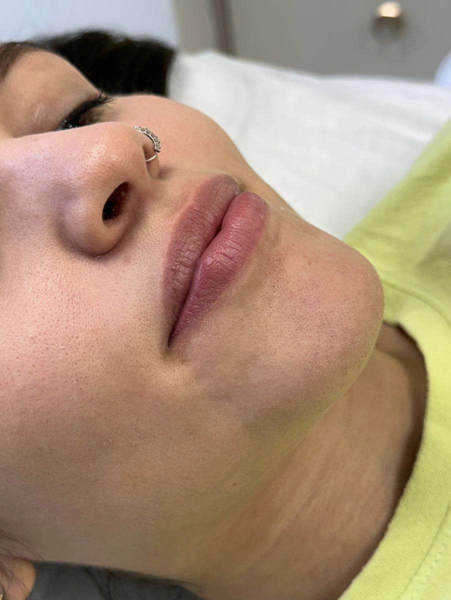 Antes do preenchimento labial na clínica de estética SENCIÊ no Batel em Curitiba