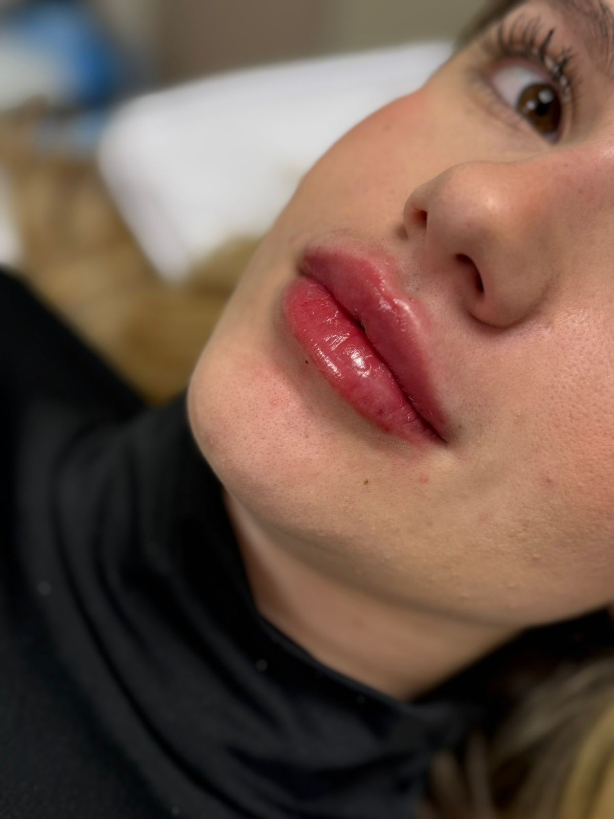 Preenchimento labial natural na clínica de estética SENCIÊ no Batel em Curitiba