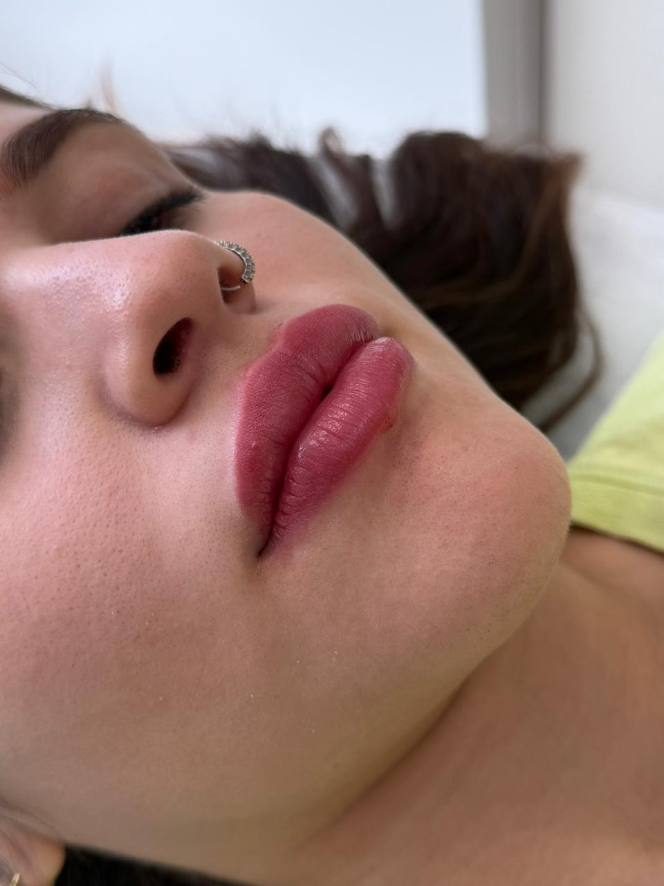 Depois do preenchimento labial com resultado natural na clínica SENCIÊ