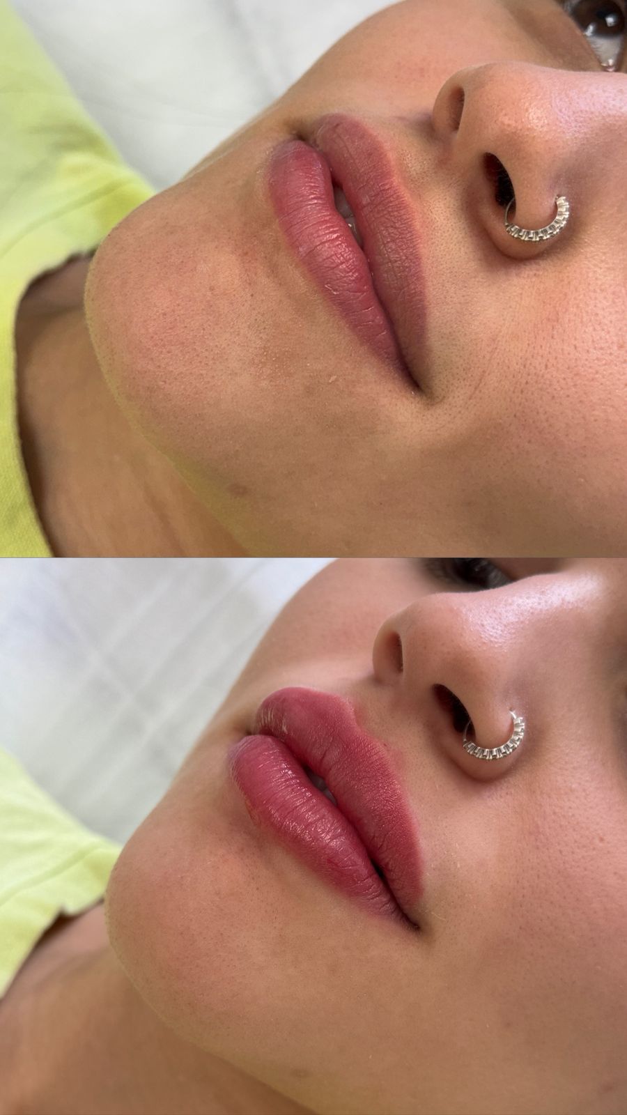 Resultado estético da clínica SENCIÊ para pacientes do Batel em Curitiba